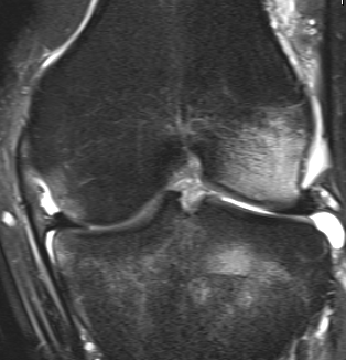 MRI ACL Rupture Bony Oedema Lateral Femoral Condyle